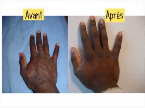 comment soulager psoriasis cuir chevelu