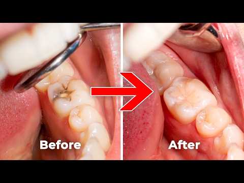 What to Expect at Your Cavity Filling Appointment (Before, During & After!)