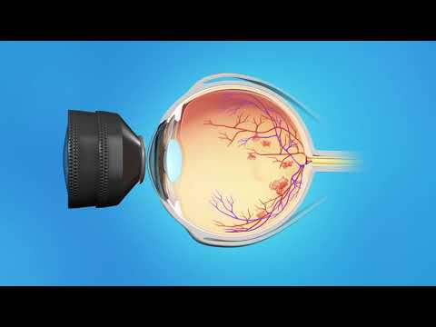 Central Retinal Vein Occlusion | Houston Retina Associates | Houston Texas