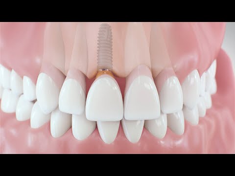 Dental Implant Procedure — 3D Patient Animation