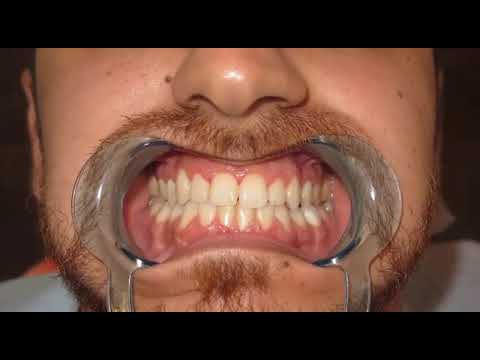 Teeth Whitening in MarmariSmile