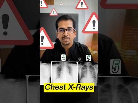 5 Chest X-rays that need Immediate Action (Must know) #xray #cxr #icu