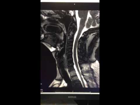 Valsalva Maneuver - Dynamic Neck MRI
