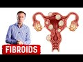 The Best Foods to Shrink Fibroids