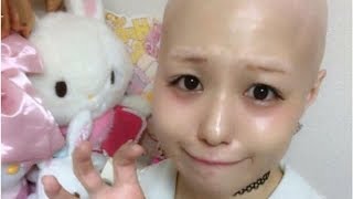 ある日突然、髪の毛を失ったアイドル「女の子やめなきゃ」葛藤を越え公表…『売名行為』との批判にも負けず