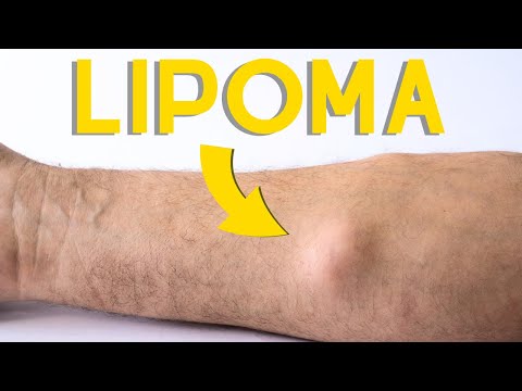 Lump or bumps underneath the skin? Benign Mesenchymal Lipoma