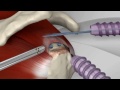 Chirurgie orthopédique épaule : réparation coiffe des rotateurs à Avignon (Vaucluse).