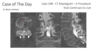 Case of the Day - 108 - 2025 09 24 - CT Myelogram - A Procedure that Continues to Live