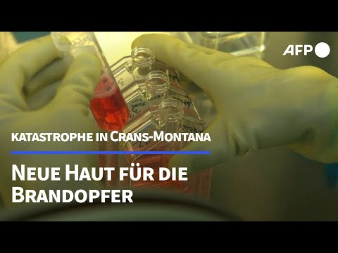Neue Haut für die Brandopfer von Crans-Montana | AFP