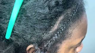 SCRATCHING UP DRY FLAKES | DANDRUFF | HAIR SCRATCHING | ASMR