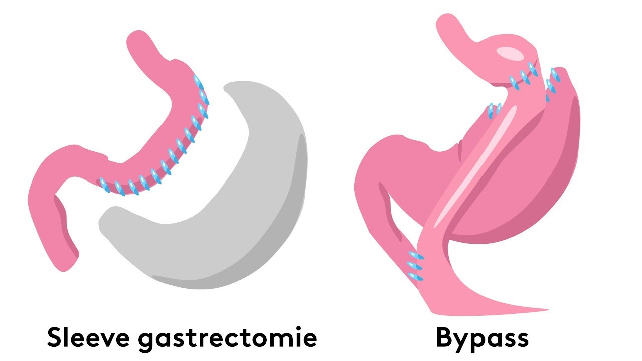 Quelles sont les techniques de chirurgie de l'obésité ?