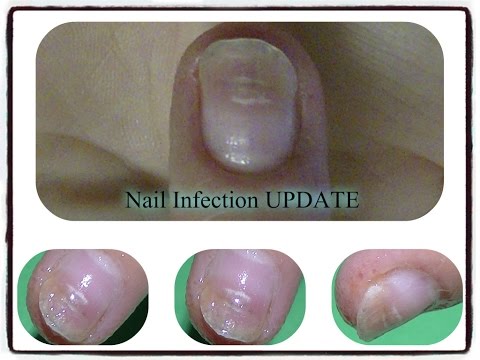My Infected Finger Update!