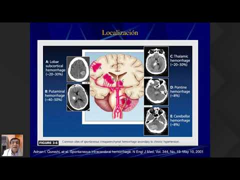 AVC Hemorrágico (Español)