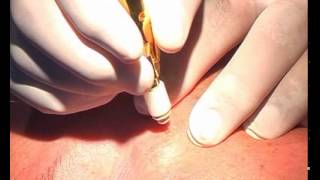 Tecnica della Crioterapia con protossido d'azoto