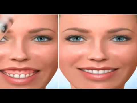 Surgery to reduce a gummy smile