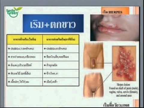 การรักษา Gagry ของโรคสะเก็ดเงิน โรคสะเก็ดเงินน้ำส้มสายชูรักษาให้หายขาด