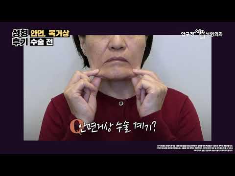 #안면거상 #목거상 1달차 사진 찍히는 게 즐거워요