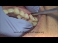 How to use luxator and forceps to remove upper decayed first molar