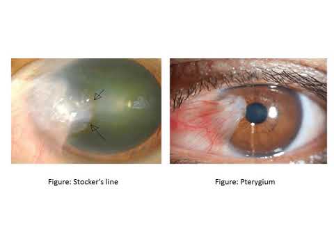 Lecture on Pterygium For 4th Year MBBS Undergraduate Students By Prof  Dr  Hussain Ahmad Khaqan