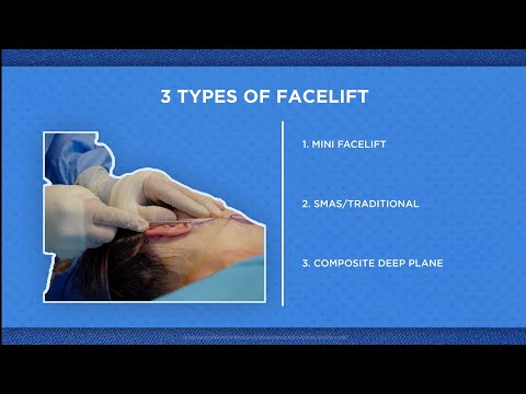 Facelift-Arten erklärt: Mini-Facelift, SMAS/Traditionelles Facelift und Deep-Plane-Facelift
