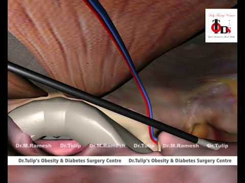 Bilateral Hernia by Totally extraperitoneal (TEP) repair Method - Animation
