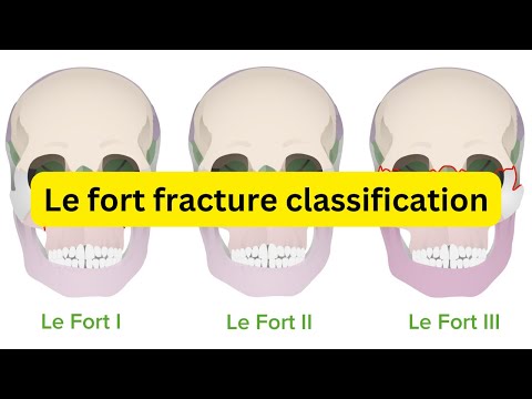 Le fort fracture classification