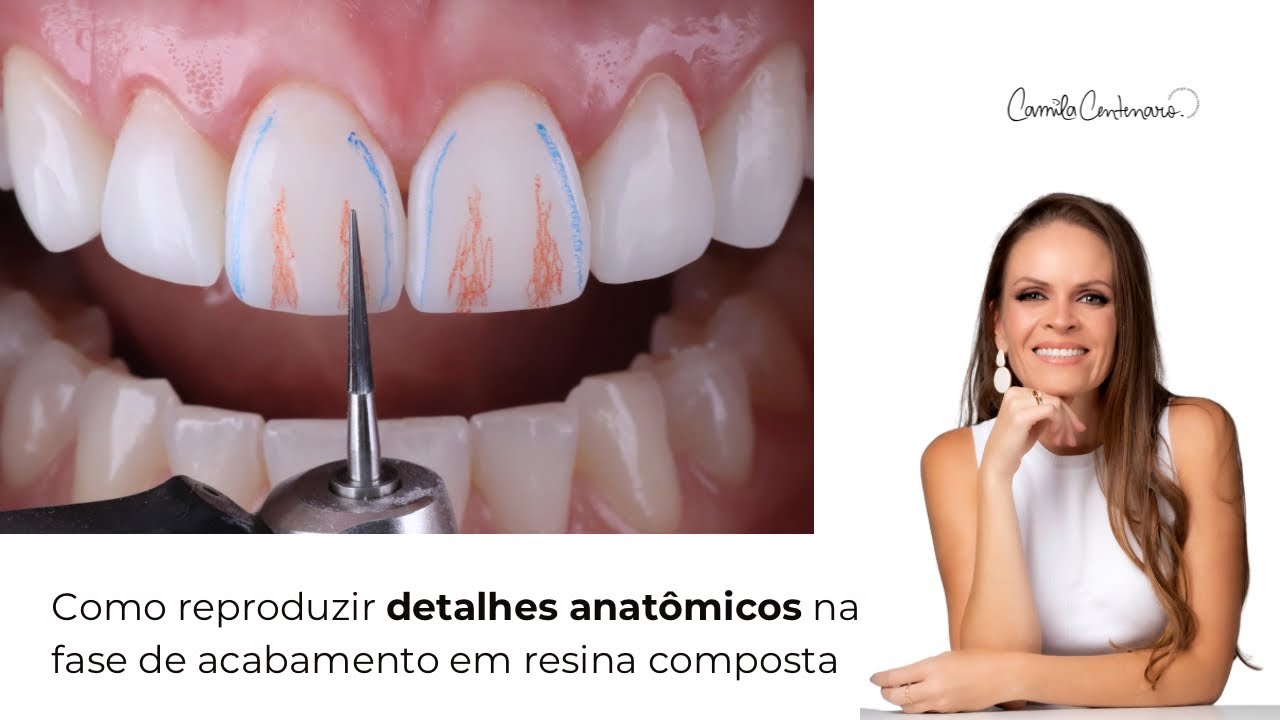 Como reproduzir detalhes anatômicos na fase de acabamento em resina composta