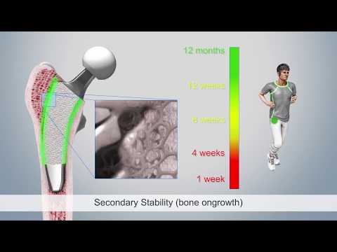 Bone integration optimys