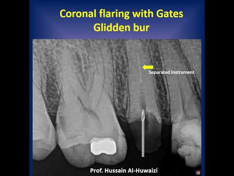 Simple steps to remove separated instruments from a root canal