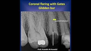 Simple steps to remove separated instruments from a root canal