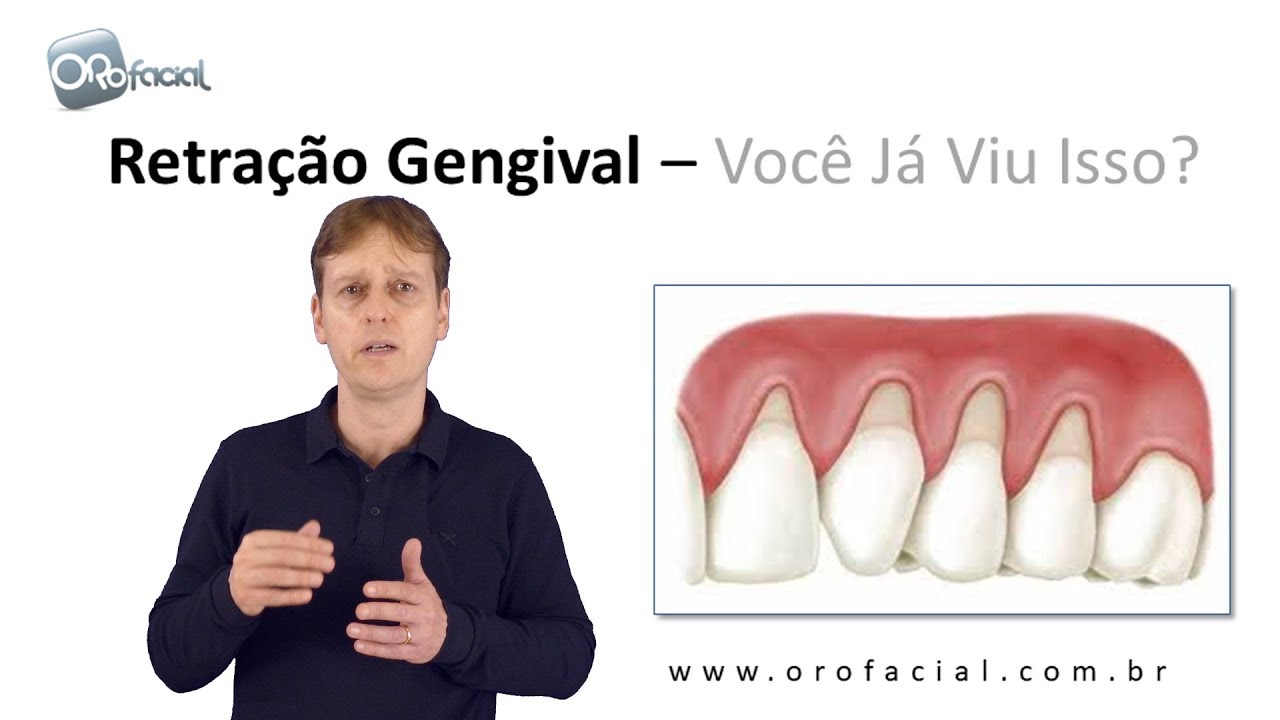Retração de Gengiva  - Você Já Viu Isso?