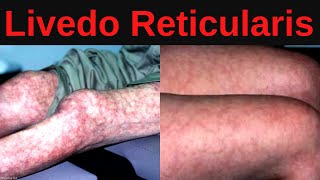 What is Livedo Reticularis? Causes, Treatment