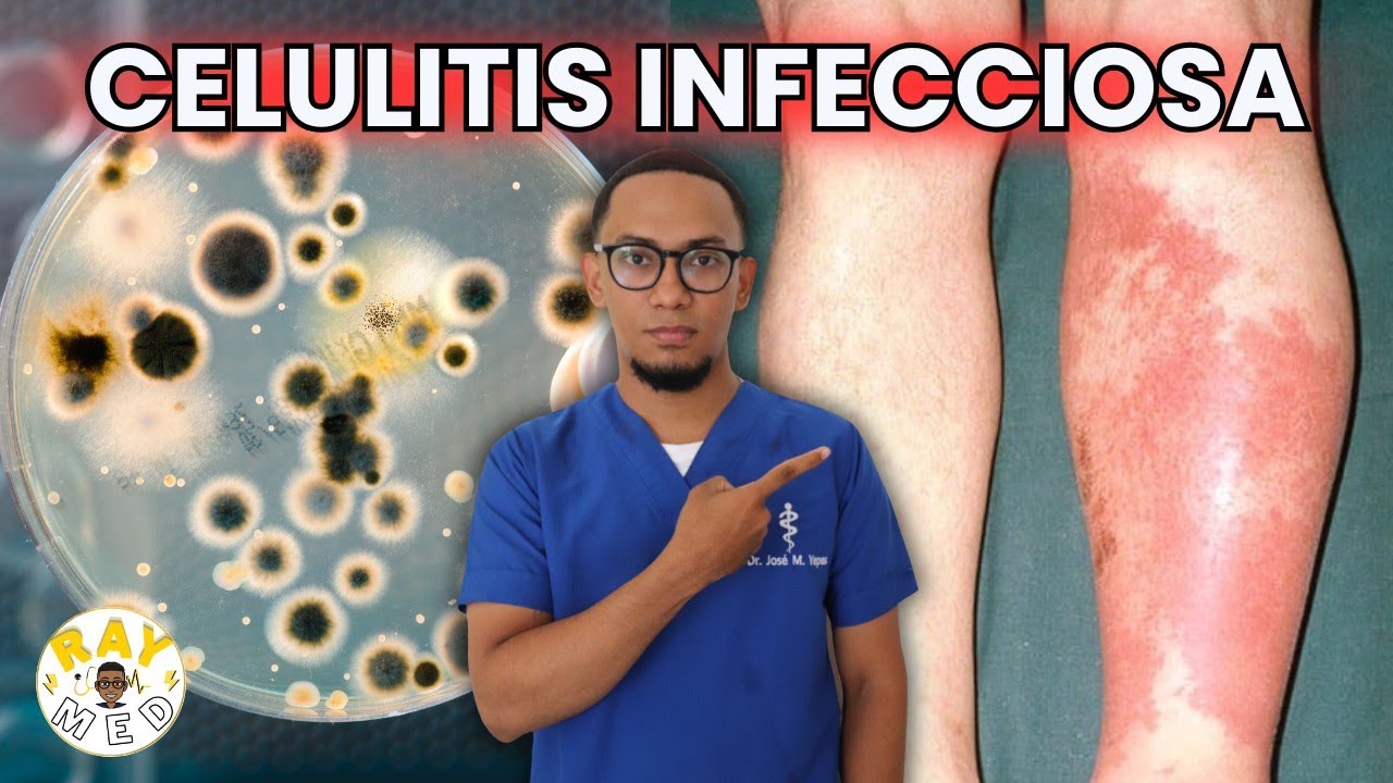 CELULITIS INFECCIOSA: ¿Qué es y como tratarla? Te lo explico en menos de 10 MINUTOS!
