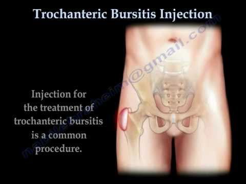 Trochanteric Bursitis Injection - Everything You Need To Know - Dr. Nabil Ebraheim