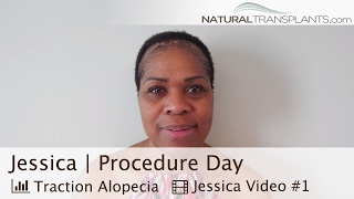 Hair Loss in Women | Natural Hair Transplant | Procedure Day (Jessica)