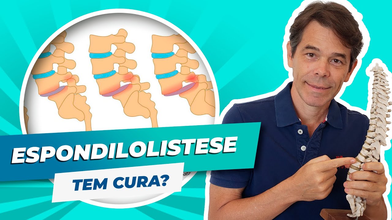 Espondilolistese tem cura? | Marcelo Garcia