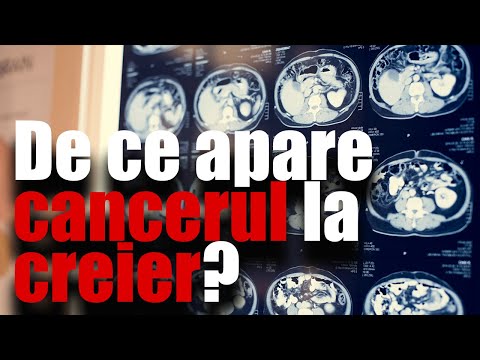 De ce apare cancerul la creier? Vine cu explicații reputatul neurochirurg Alexandru Vladimir Ciurea!