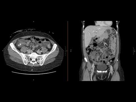 Abdominal Imaging Call Prep Cases: Acute Uncomplicated Appendicitis (CT) Case 1 Discussion