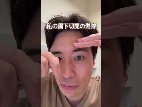 医学科 私の受けた眉下切開の傷跡