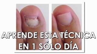 Curso de podología: Reconstrucción de la uña