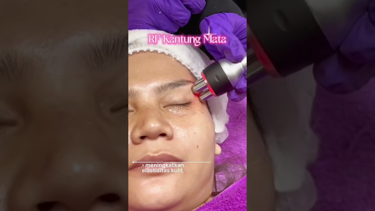 Mata sembab, kantung mata tebal, atau terlihat lelah terus? Saatnya Treatment RF Kantung Mata !