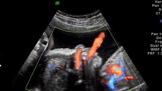 Fetal breathing of amniotic fluid in color Doppler