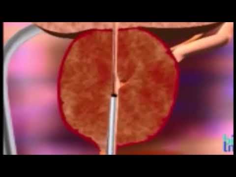 Trattamento della prostatite cronica prostatilenom Trattamento pomo dAdamo di prostatite