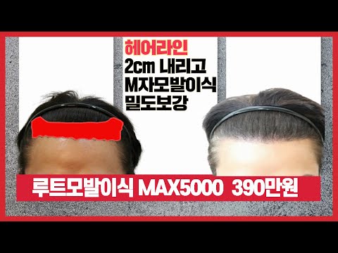 모발이식 남성헤어라인내리고 M자모발이식 밀도보강 모든것이 MAX5000  390만원입니다