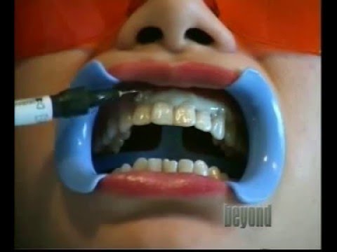 Dental Bleaching
