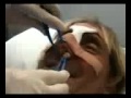 Nose Job Packing Out