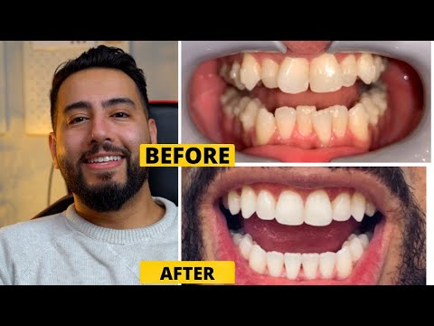 Is INVISALIGN worth it? - MY REVIEW - everything you need to know