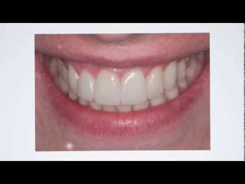 Freshdental transformations dentist London, dentist Holborn and dentist Bolton case gallery