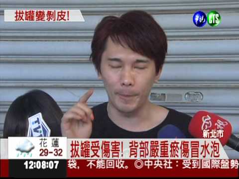 拔罐太頻繁! 男子瘀傷冒水泡