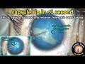 Capsule Rip during intumescent white cataract surgery (Argentinian Flag Sign)